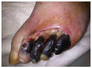 آمپوتاسیون پا