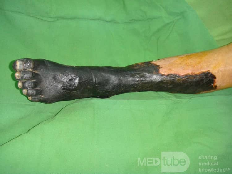 قطع پا دیابتی