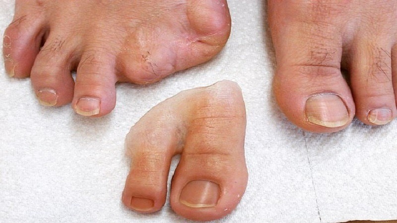 استفاده از پروتز زیبایی برای انگشتان پا