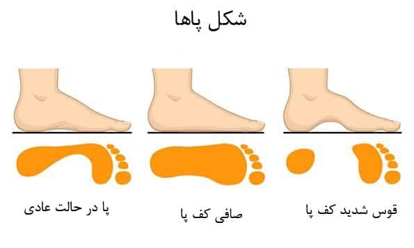 صافی کف مشکلاتی را ایجاد میکند و برای رفع مشکل باید از کفی طبی استفاده کرد